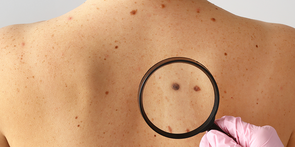 How To Find Out Skin Cancer?
