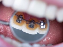 Teeth Straightening Uk | Tower House Dental Clinic